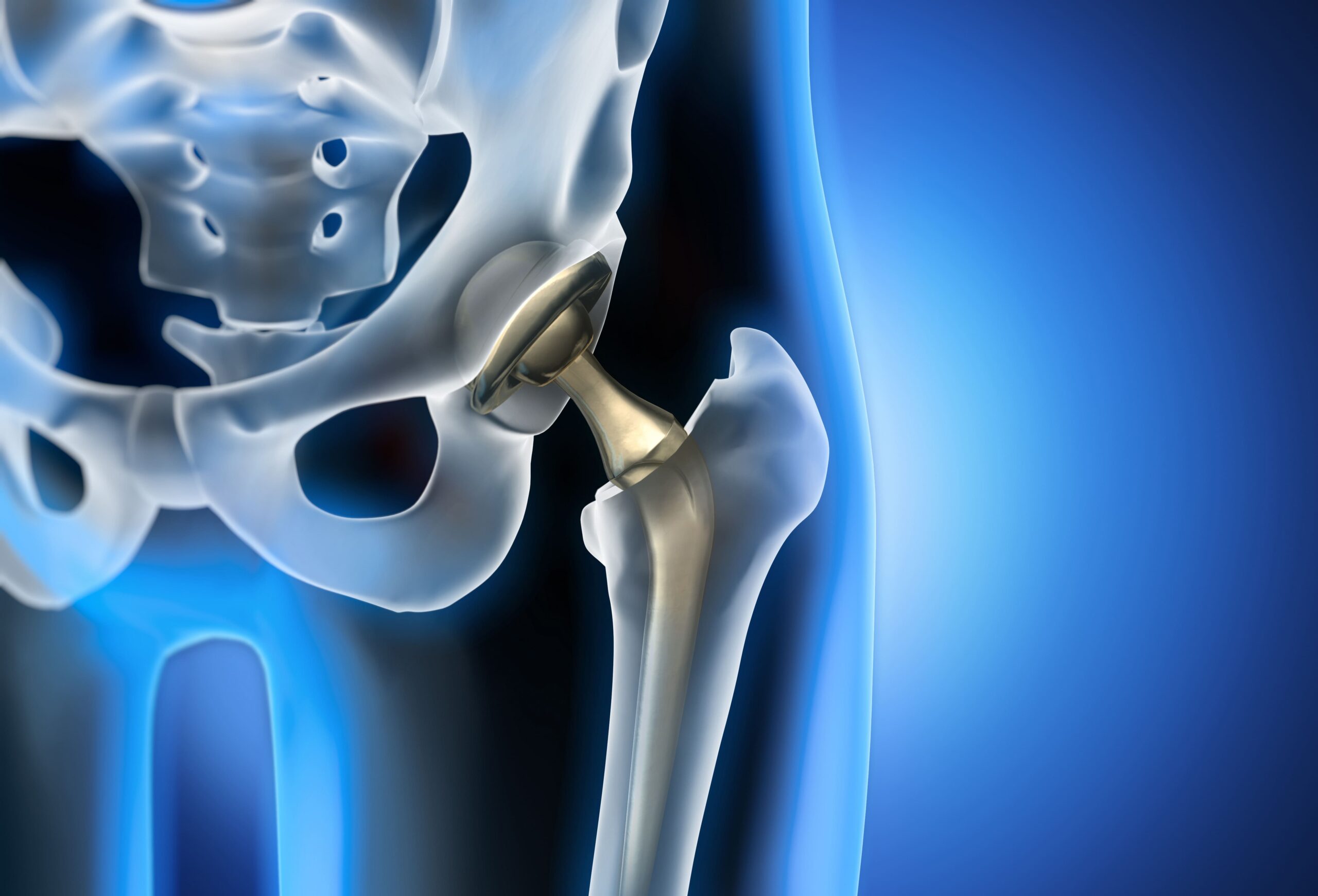 X-ray image of a hip showing a Hip replacement.