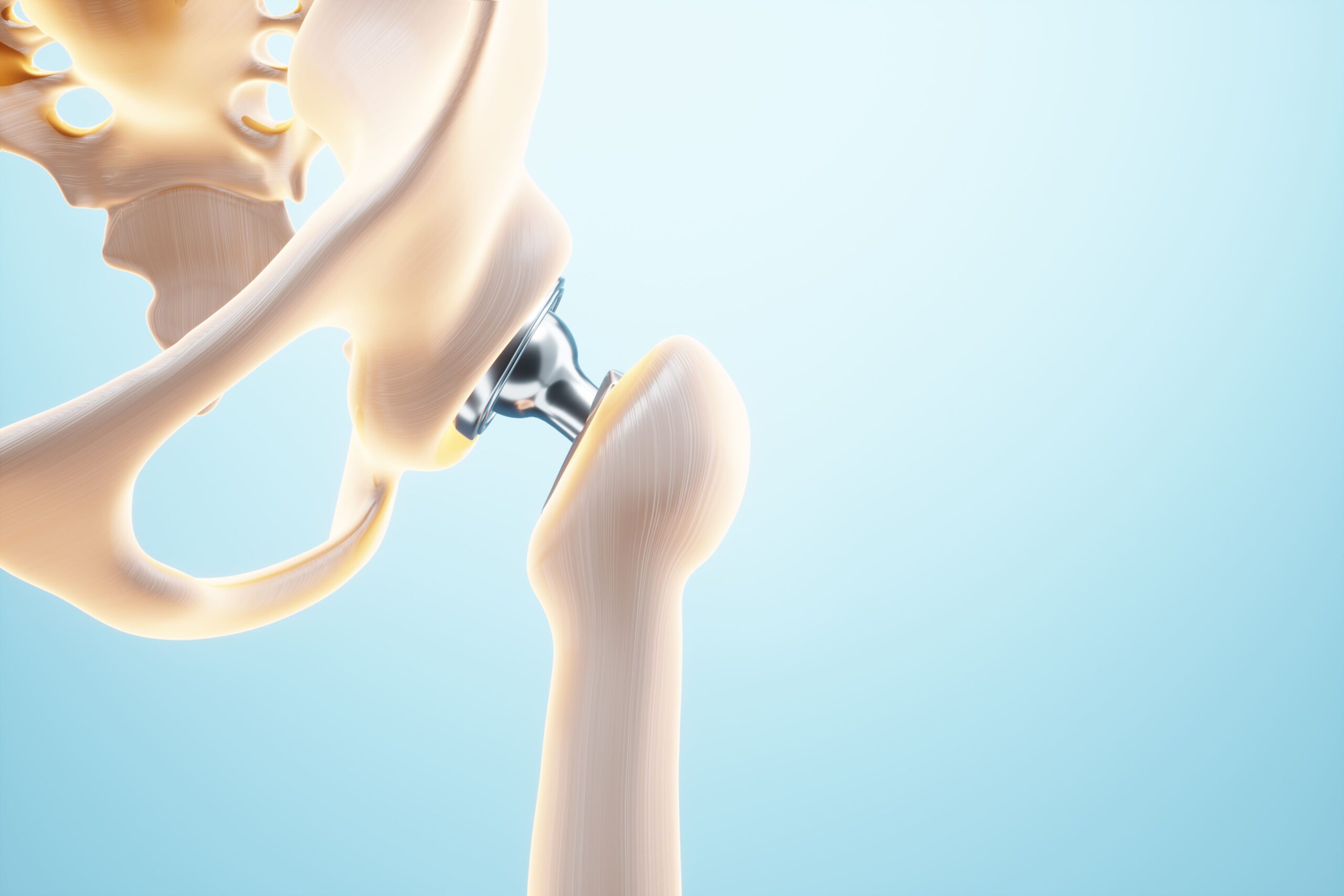 3D rendering of a hip joint with a prosthetic implant, illustrating the placement of the hip prosthesis within the bone structure.
