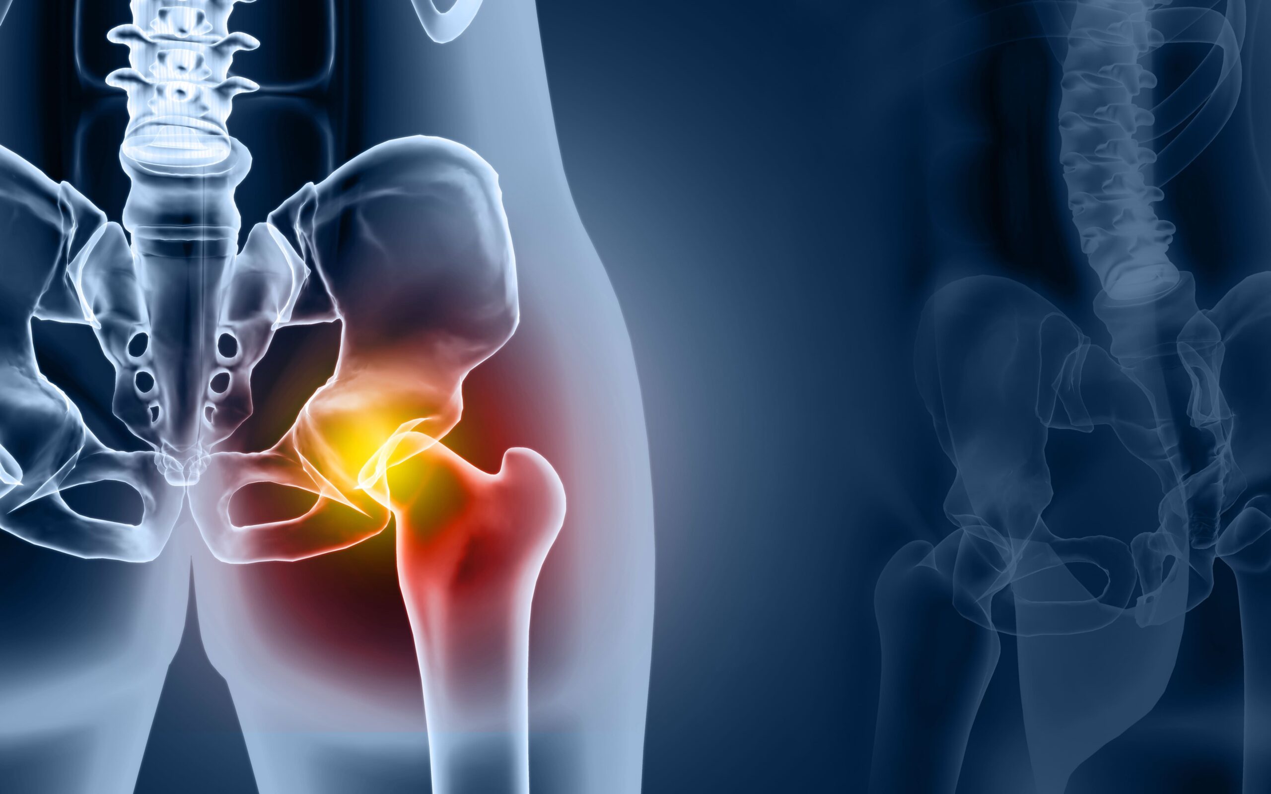 X-ray illustration showing a highlighted hip joint affected by Hip osteoarthritis.