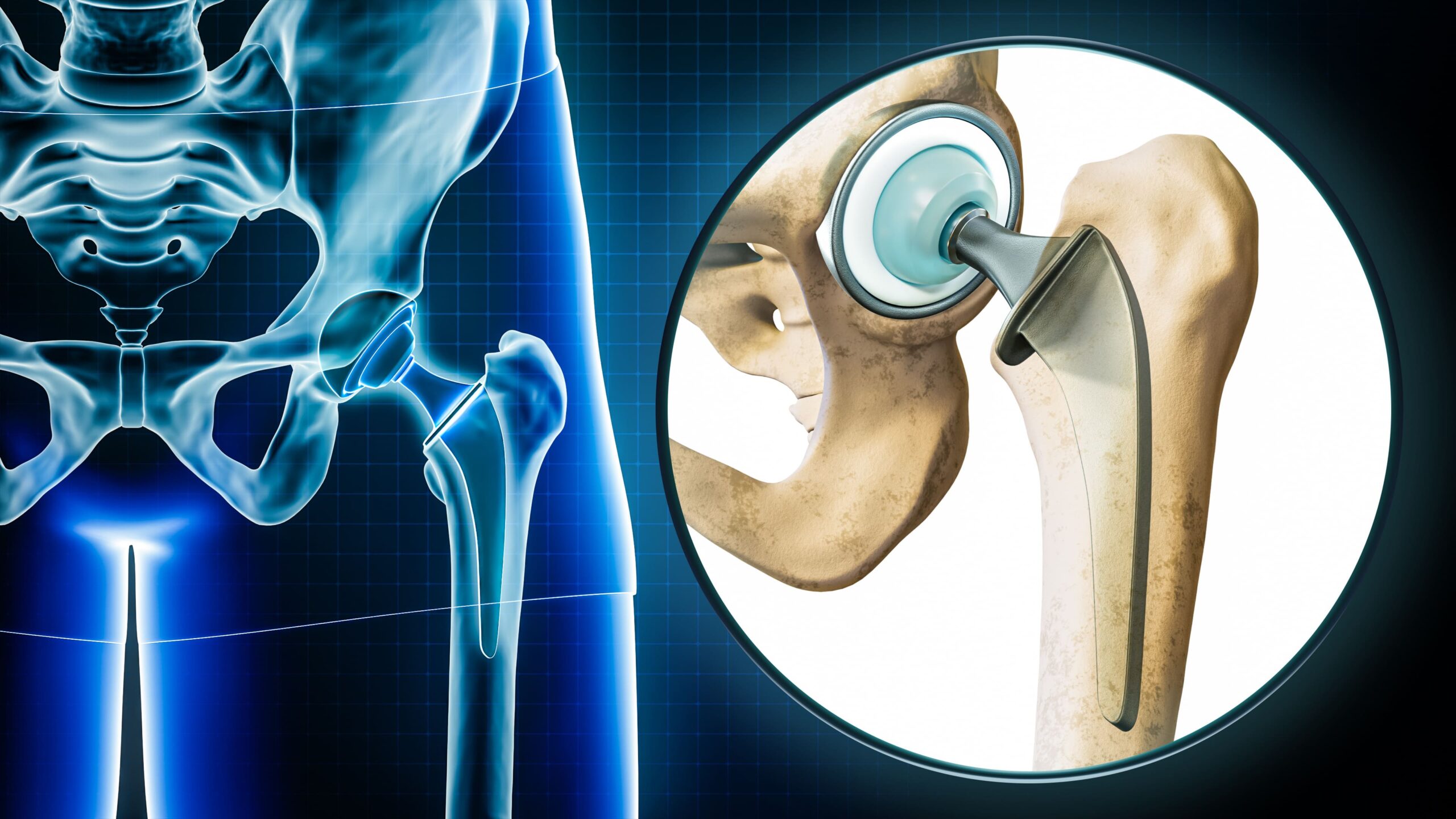 A detailed X-ray and close-up view of a hip joint with an invasive hip replacement prosthesis, illustrating the components used in invasive hip replacement surgery.