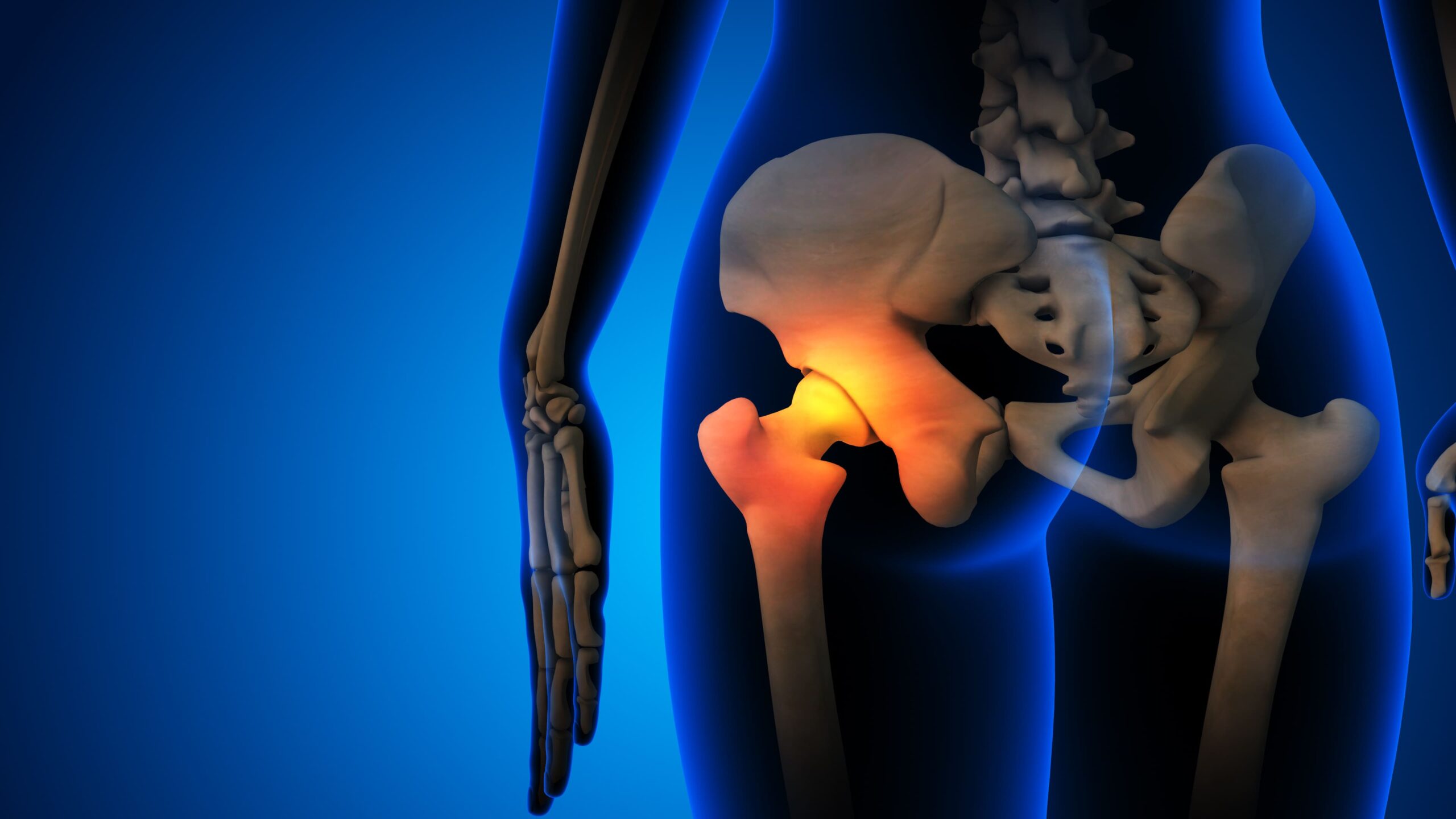 X-ray illustration highlighting the hip joint area, showing inflammation associated with Hip surgery.